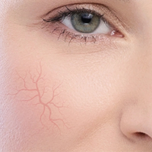 DERMEDIC REDNESS CALM Krem koncentrat na chroniczne zaczerwienienia, 40ml