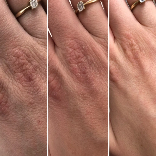 Swederm HudSalva Sensitive Maść do skóry suchej i atopowej, 50 ml