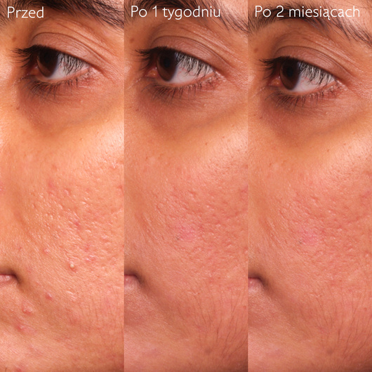 Caudalie Vinopure Serum z kwasem salicylowym na niedoskonałości, 30 ml